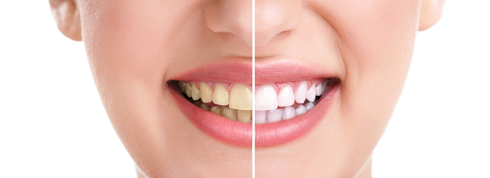 An image of a person smiling, with a close-up view highlighting teeth whitening.